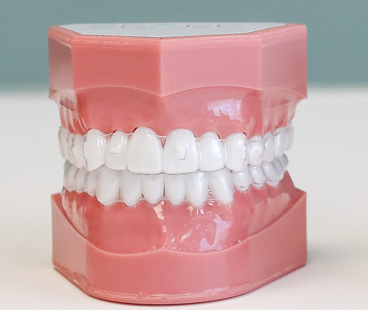 Gouttières (Aligneurs)